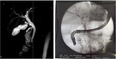 Single stage laparoscopic cholecystectomy with intraoperative endoscopic retrograde cholangiopancreatography for cholecysto-choledocholithiasis. Lesson learnt from the COVID-19 pandemic
